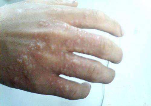 手上得汗疱疹疼该怎么办,手上汗疱疹奇痒用什么药