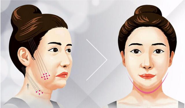 埋线提升,埋线提升需要几根线