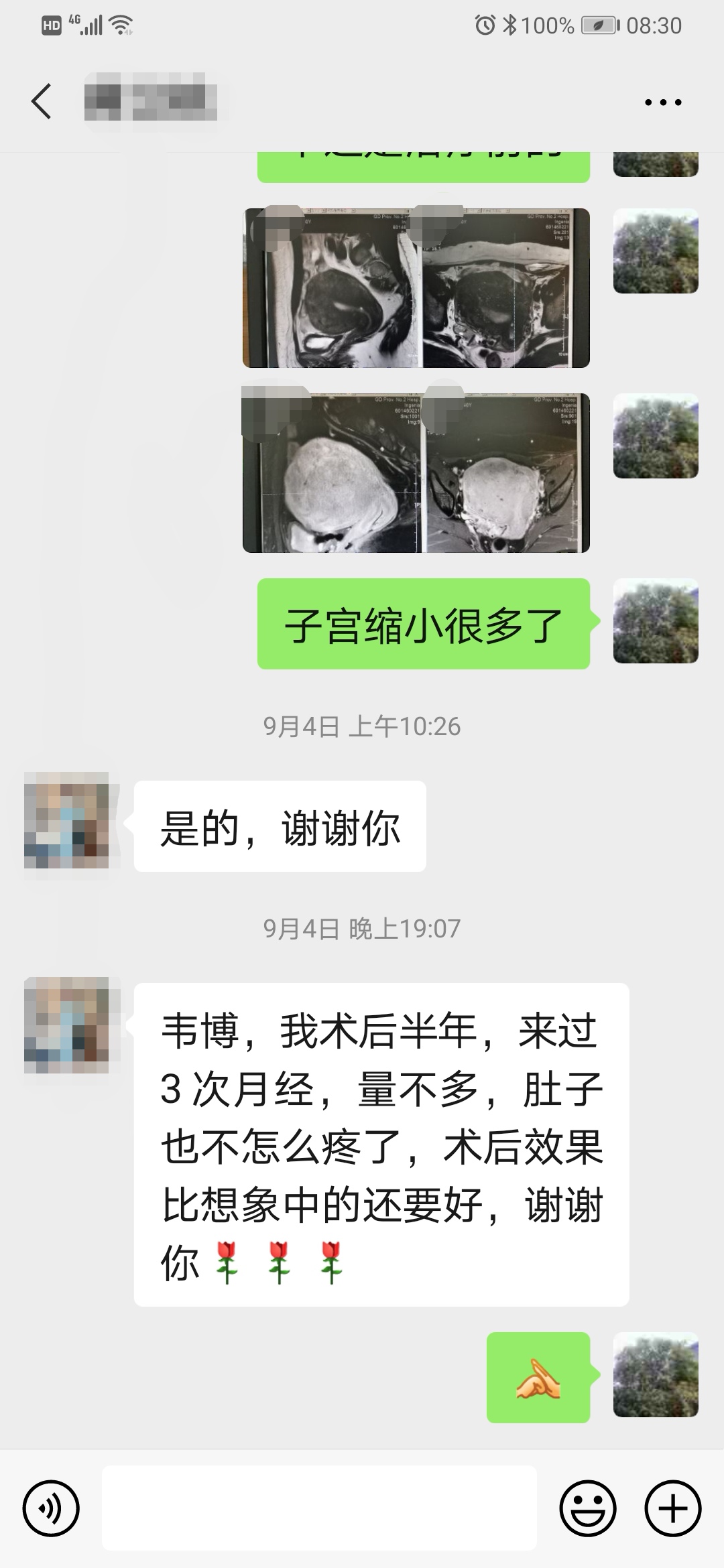 子宫腺肌症痛经中医能治好吗,子宫腺肌症引起的痛经艾灸哪里