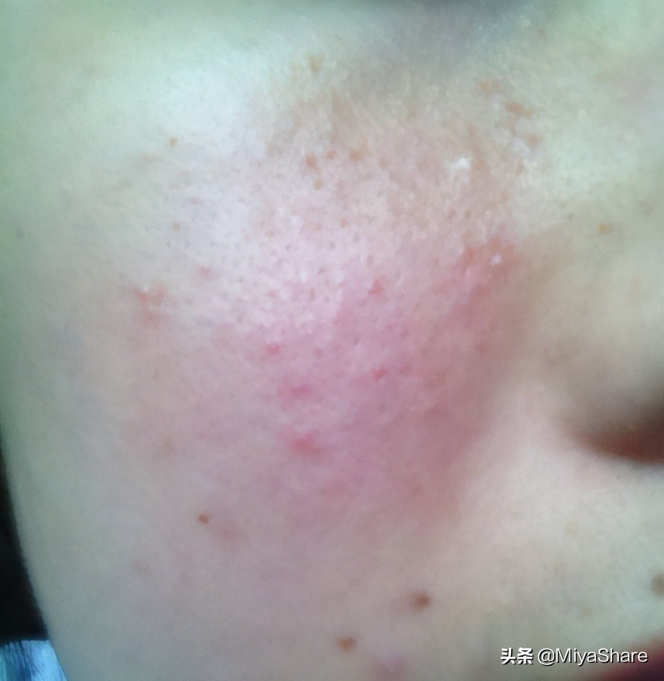 又油又起皮怎么护肤最好,如何分区护肤流程图片