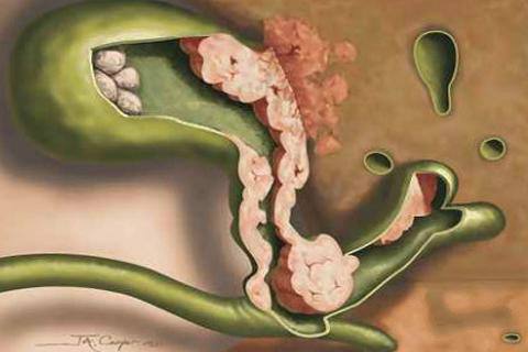 老年人胆囊炎怎么治疗效果最好,老年胆囊炎的症状及治疗