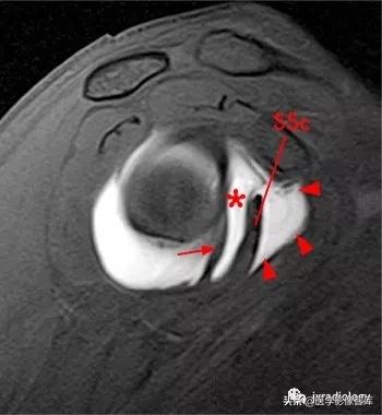 肩关节滑膜解剖,肩关节周围肌肉解剖