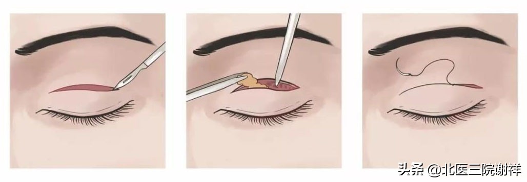 做完双眼皮还是肿着怎么办,全切双眼皮松解后能变回单眼皮吗