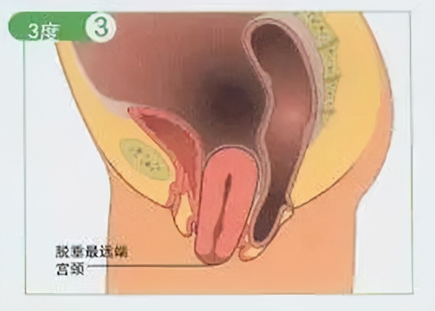 产后子宫脱垂膨出怎么办,哪些妈妈容易出现产后子宫脱垂