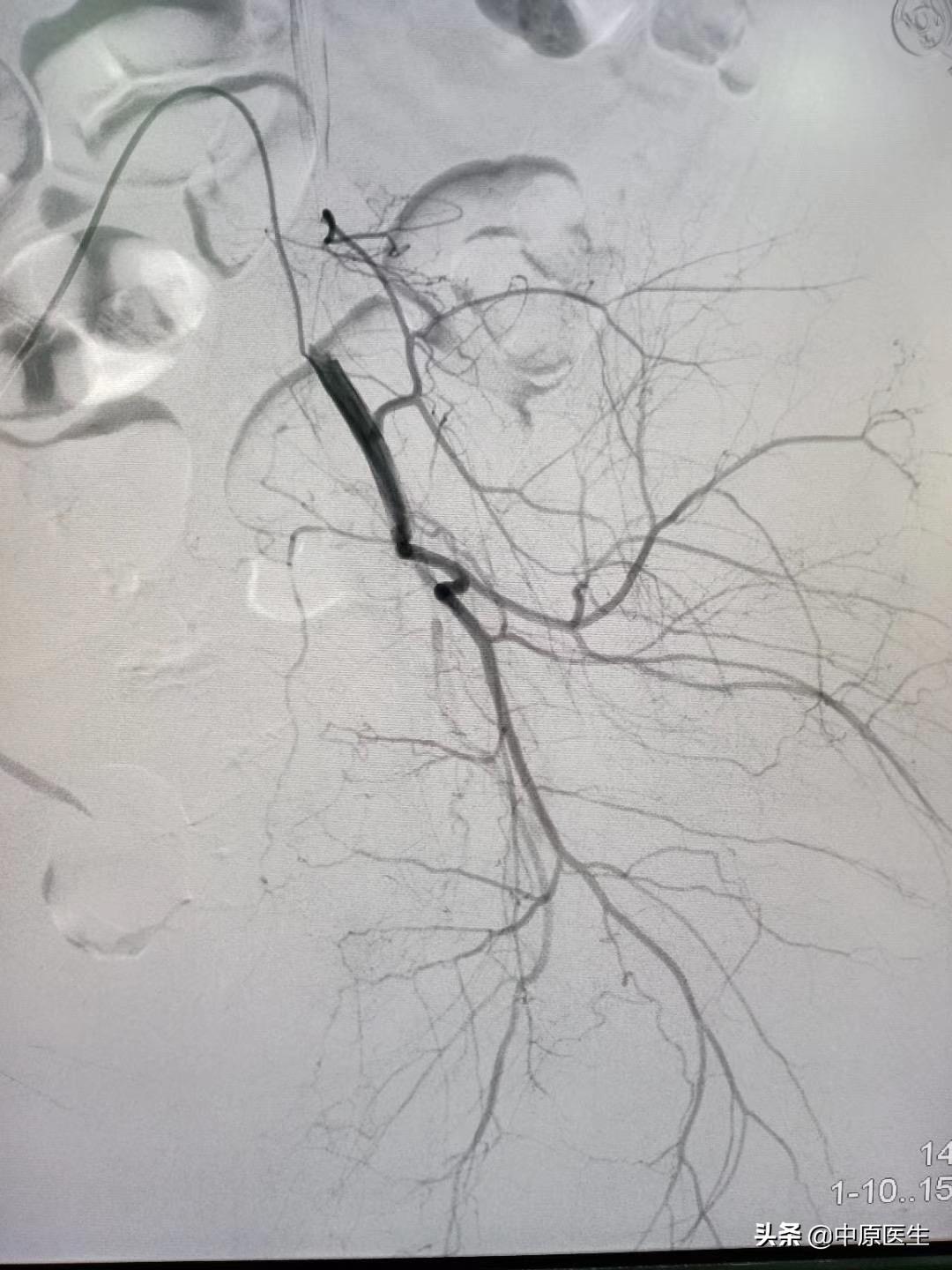 鎴戝湪鏂板啝鐤儏涓殑缁忓巻,鍦ㄦ柊鍐犵柅鎯呮劅鏌撲笅鐨勬垜