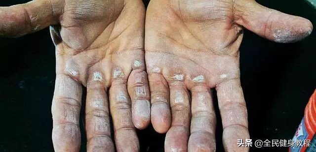 手上磨出茧子怎么才能恢复,训练手上的茧怎么消除