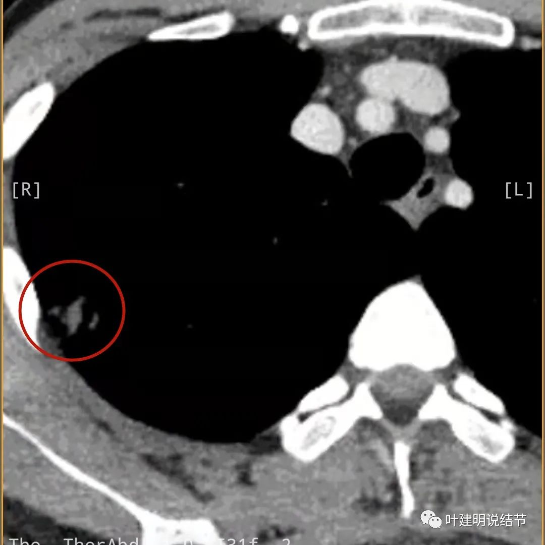 临床诊断孤立性肺结节,空洞型结节一般是什么性质