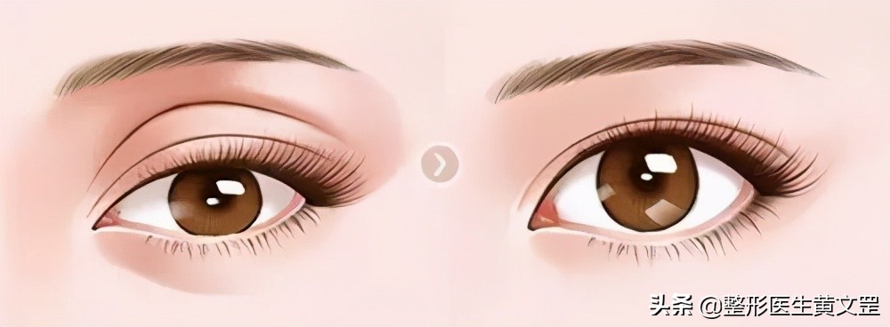 为什么眼皮一夜之间变成多层眼皮,怎么缓解多层眼皮