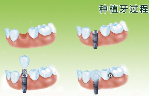 缺牙不想种植也不想镶,缺牙时间长了还能镶吗