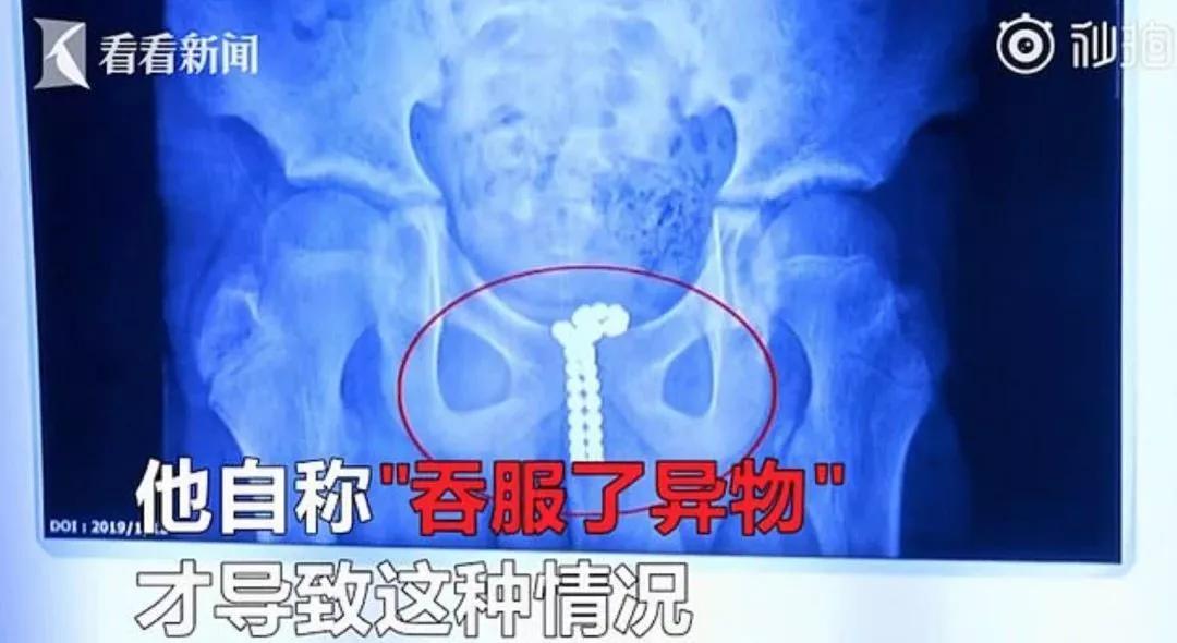 熊孩子用弹弓射人被垃圾车送走,9岁男孩把飞镖塞下来