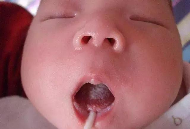 鹅口疮与残留奶块鉴别,鹅口疮和奶垢的区分