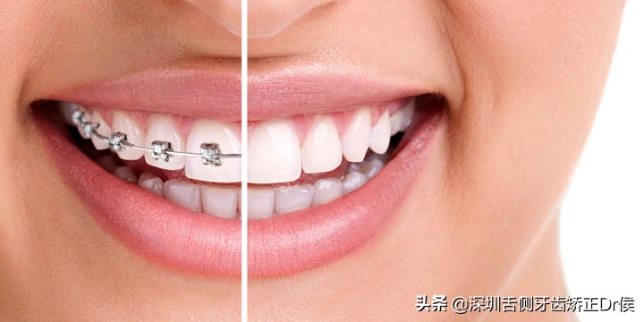 牙根短能补牙吗,牙根短能不能矫正牙