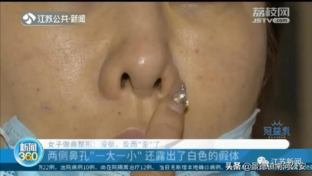 整容鼻头歪了如何修复,女子整容后全身颤抖