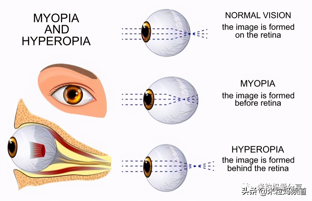 贾静雯的女儿眼睛是远视还是近视,贾静雯眼近视多少度