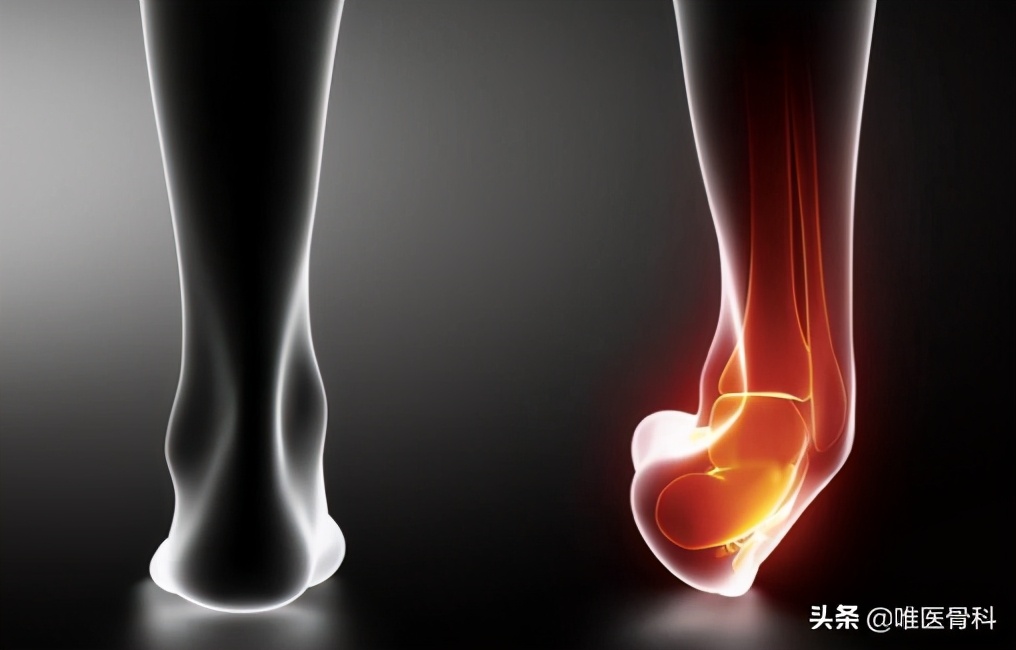 崴脚之后要立刻活动,崴脚了该不该活动