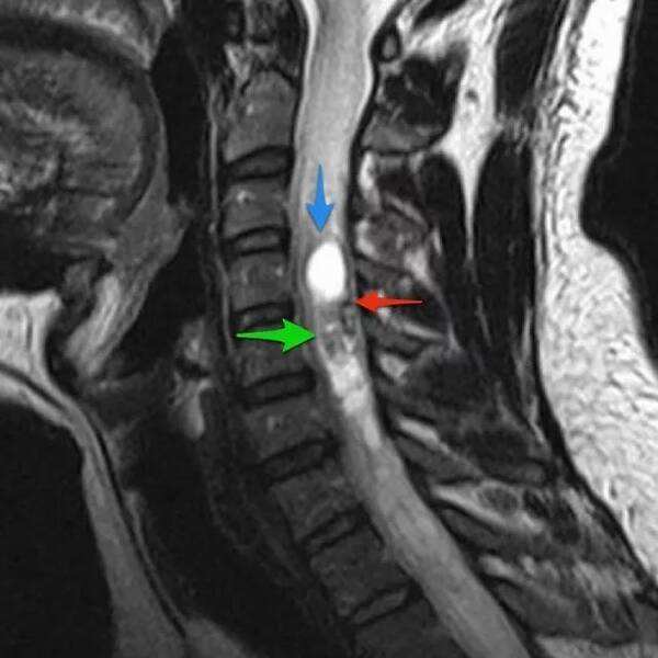 核磁结果显示骨髓水肿？如何治疗？如何预防？听听医生怎么说