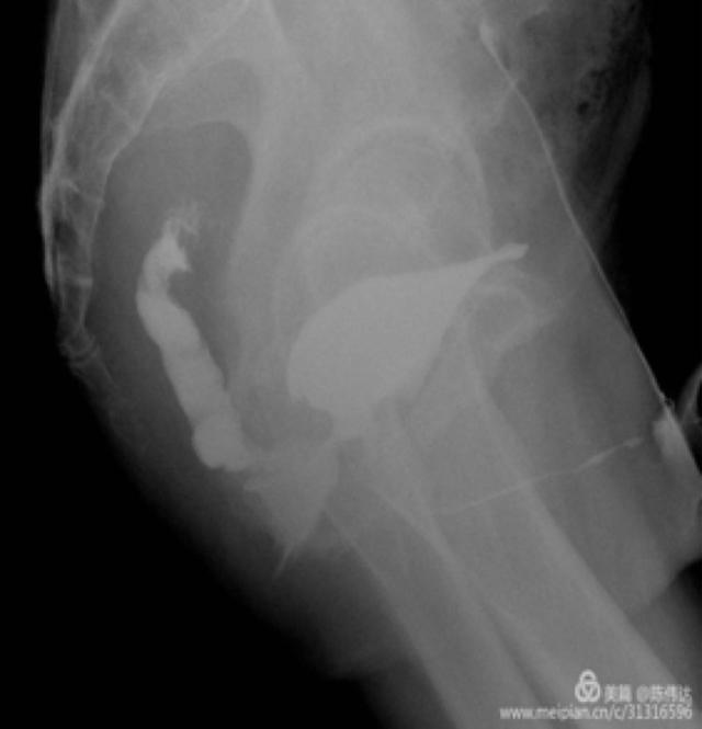 膀胱直肠瘘是什么病,直肠尿道瘘是直肠癌的症状吗