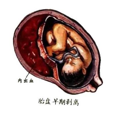 孕期发现出血需要做什么检查,孕期出血原因不明
