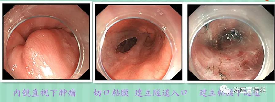 微创创伤恢复,胃肠微创手术恢复快吗