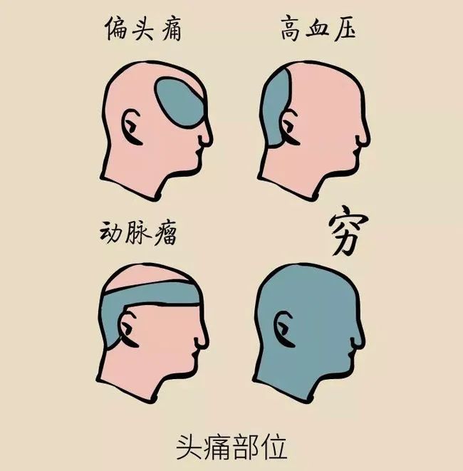 动脉瘤破裂时有什么症状,颅内动脉瘤有什么症状和表现