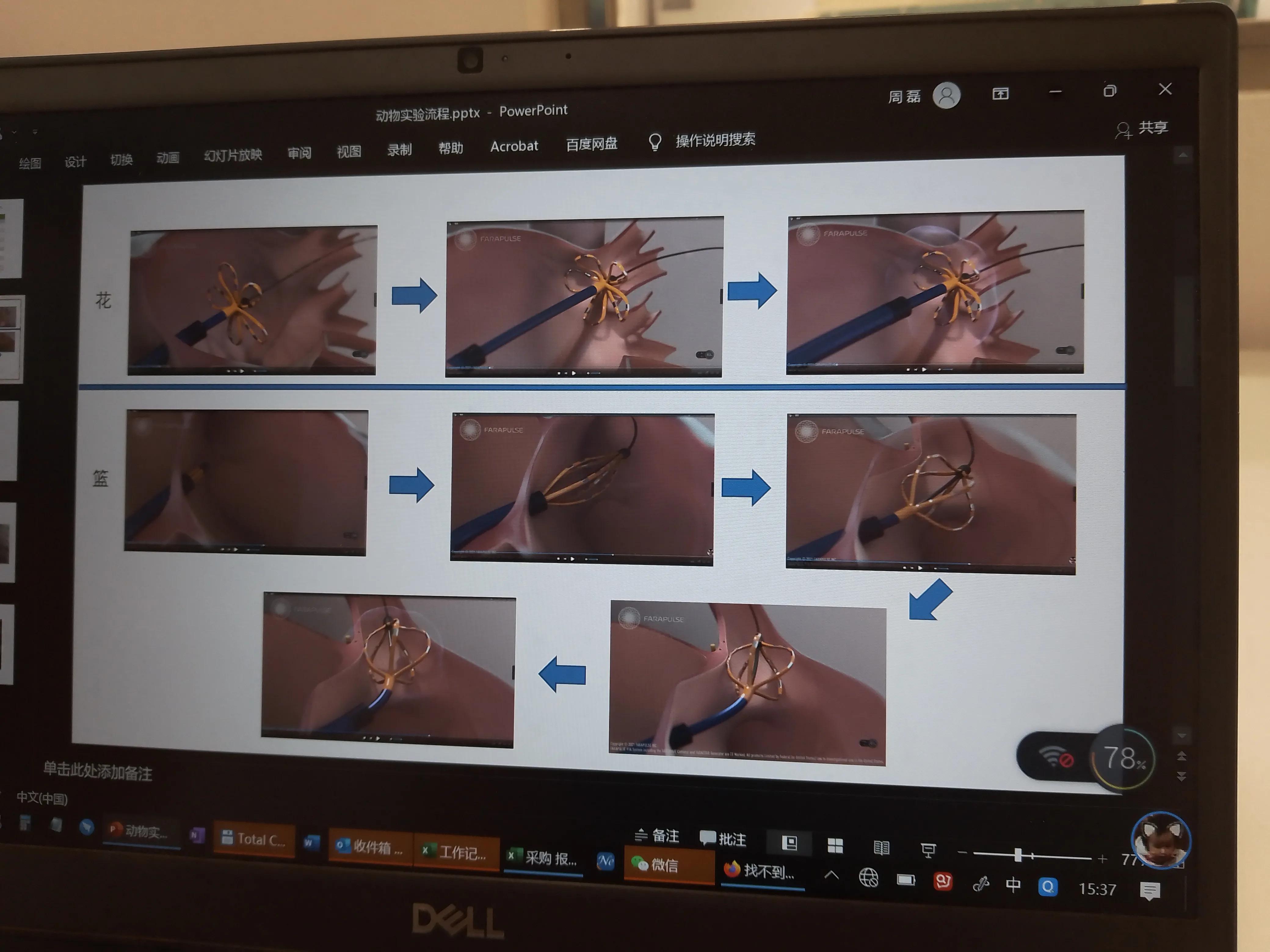 房颤射频消融术器械有哪些,脉冲消融治疗房颤品牌