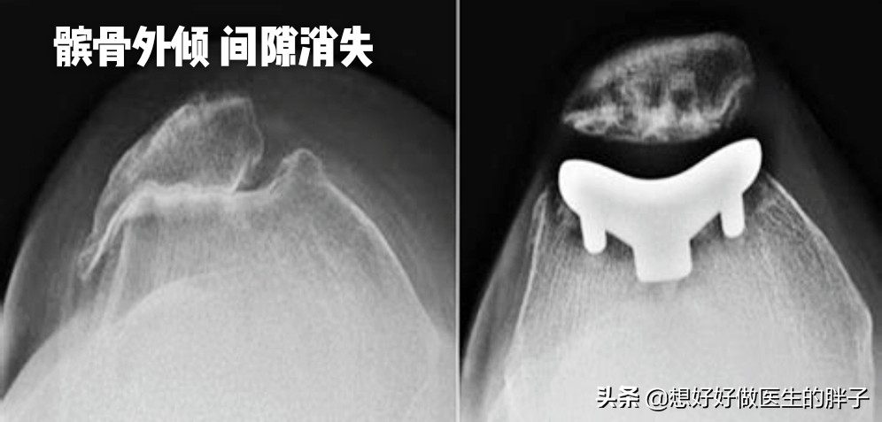 医院治髌骨软化症怎么样,专家教你快速治疗膝关节