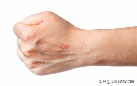 每年初夏手都会脱皮是怎么回事,手每年春天手掌脱皮是什么原因