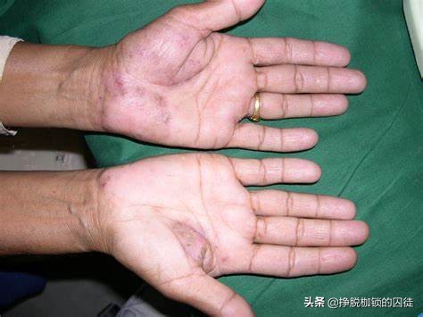 每年初夏手都会脱皮是怎么回事,手每年春天手掌脱皮是什么原因