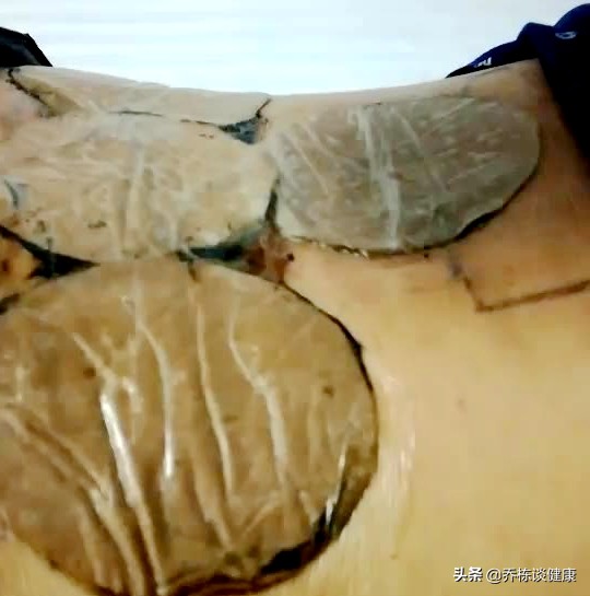 频繁腰痛十多年，吃药到胃痛，贴膏药过敏，还该怎么办？