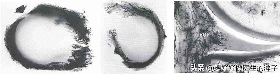 为什么足球运动员不会半月板受伤,足球运动半月板损伤