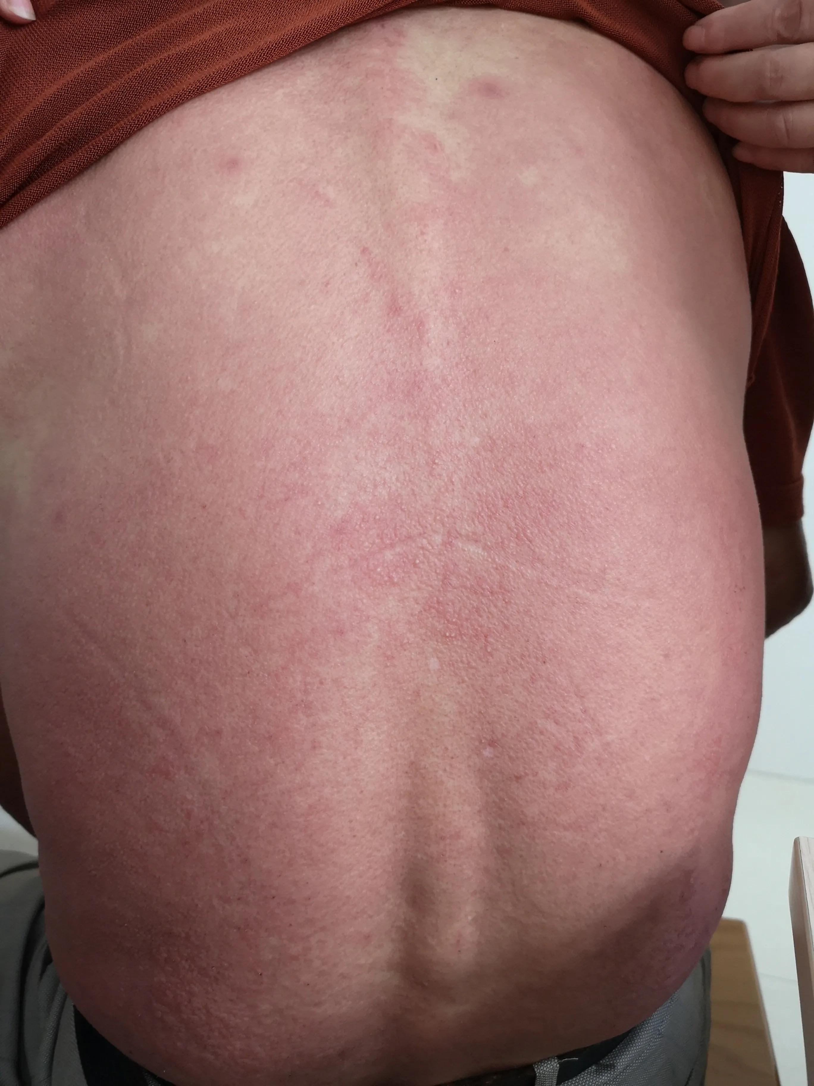 做了皮试但依然过敏死亡,皮试阴性一定是不过敏吗