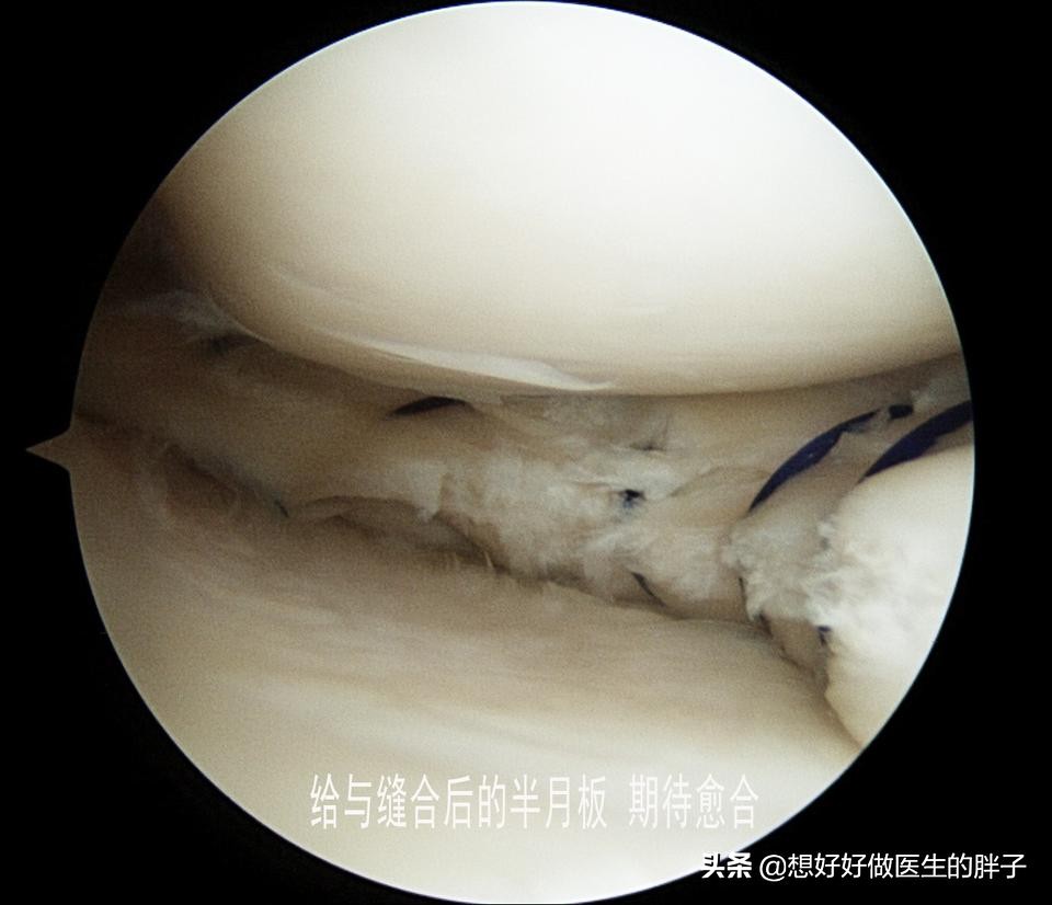 半月板损伤对足球运动员有多严重,足球运动员有半月板问题吗