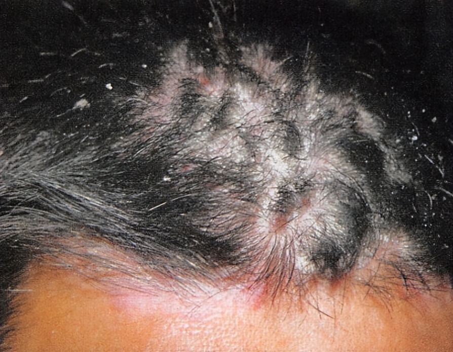 脂溢性皮炎头皮还能长头发么,头皮脂溢性皮炎与白头发有关