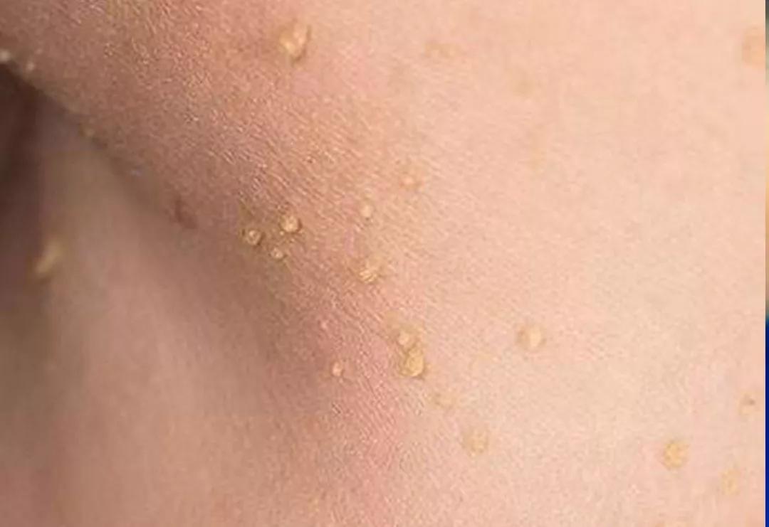 耳朵边有颗大痣这个位置会病变吗,什么样的痣容易癌变不能点