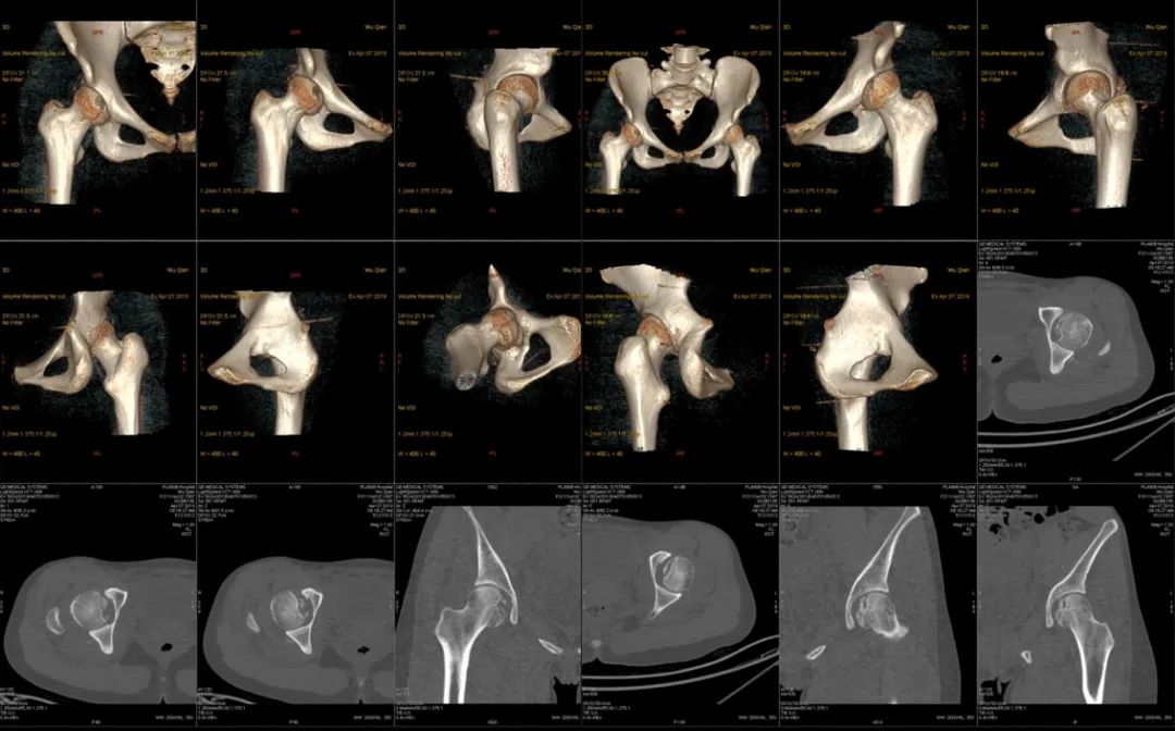 老人股骨头骨折手术,股骨头骨折最佳手术方法