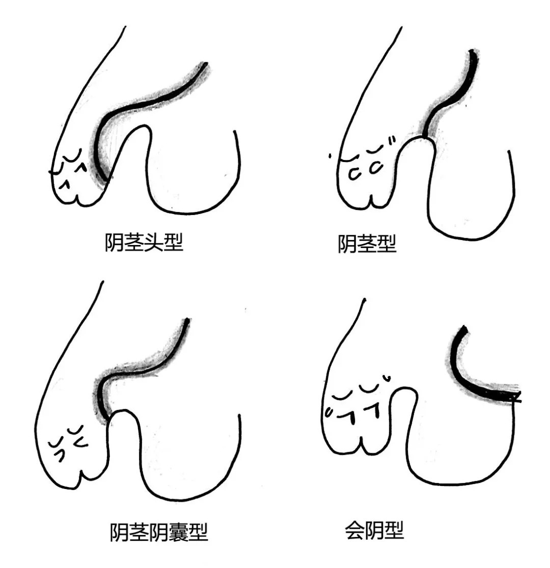 尿道下裂情况多吗,尿道口下裂有什么症状