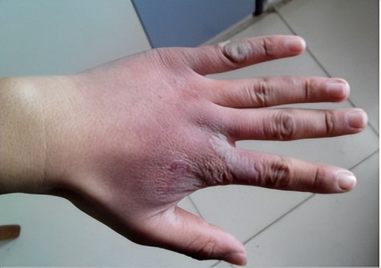 河北省中医院陈旧疤痕好修复吗,郑州第二中医院治疗疤痕怎么样