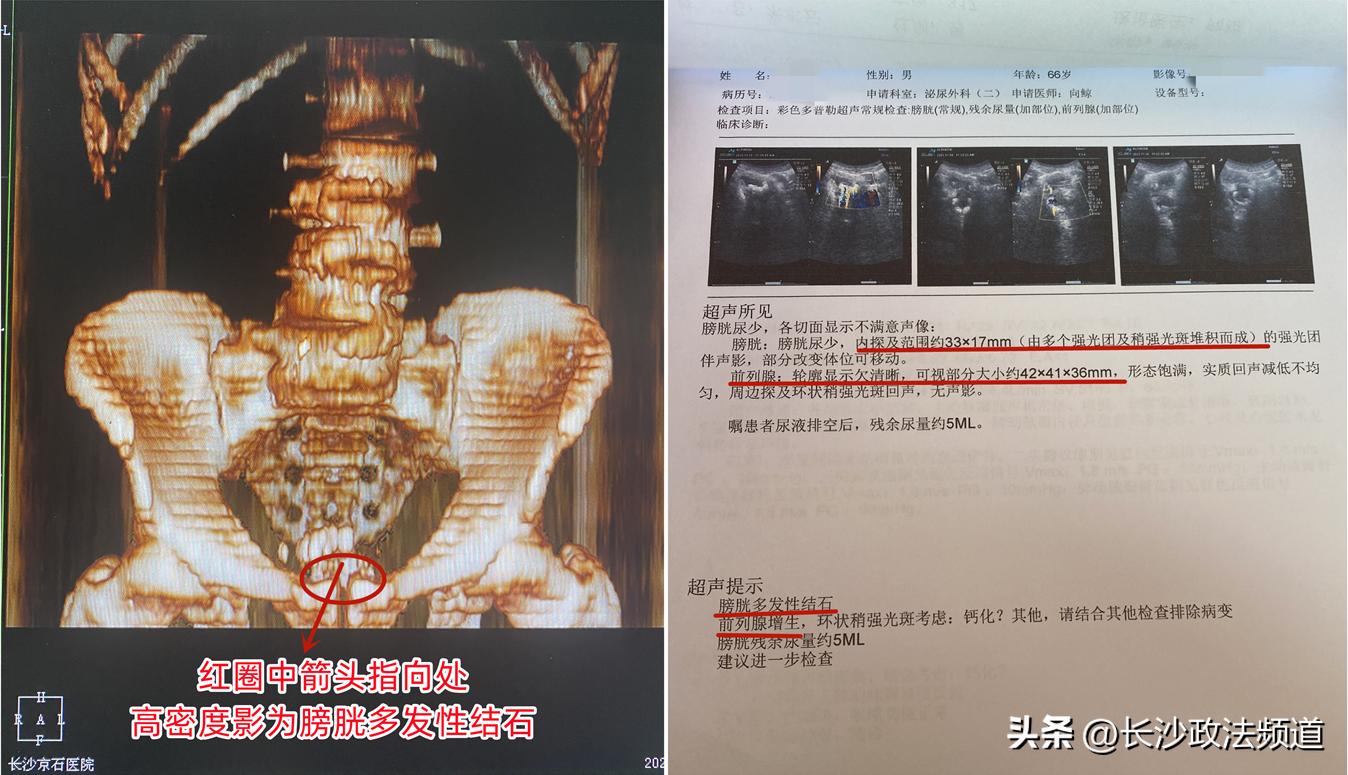 嗲嗲长期夜尿十几次却霸蛮硬抗，今突然尿不出、尿血方紧急就医