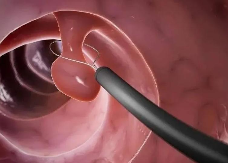 防止内膜息肉复发需要上曼月环吗,内膜息肉怎么防止复发备孕