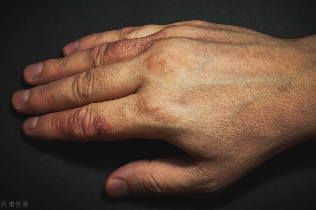 湿疹反反复复的最佳治疗,湿疹反反复复不好怎么调理