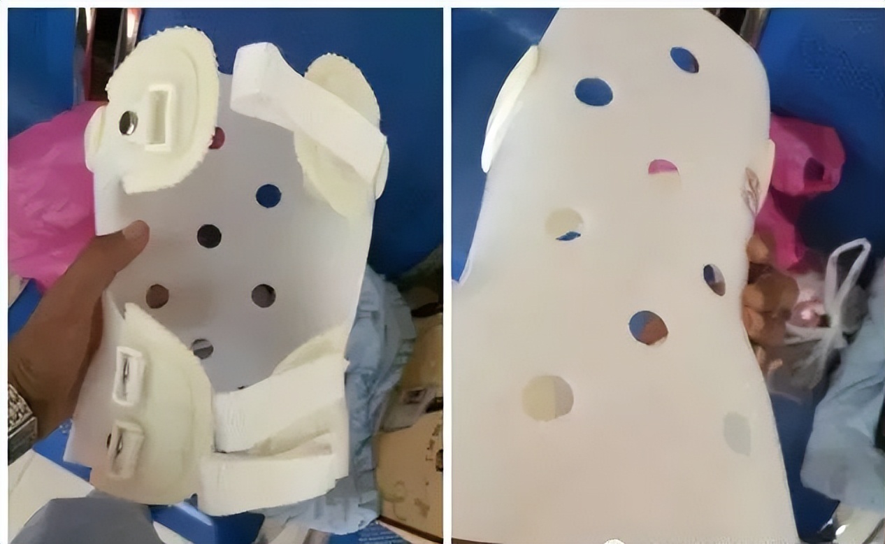 脊柱侧弯矫正支具不调整会怎样,简单辨别脊柱侧弯避免孩子走弯路