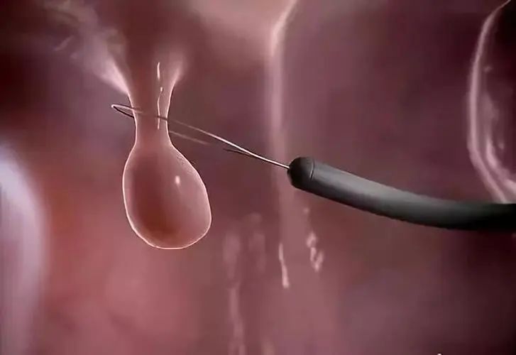 体检报告息肉没有显示大小吗,结肠息肉0.4切除后还会癌变吗