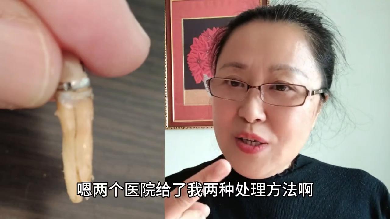 不同医院的同一品牌全瓷牙,牙齿隐裂牙神经挑好还是不挑好