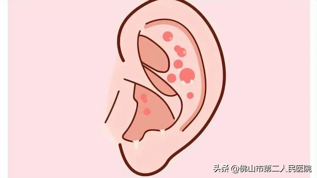 宝宝总是用手抠耳朵是有湿疹吗,宝宝耳朵长湿疹抓耳朵睡不好