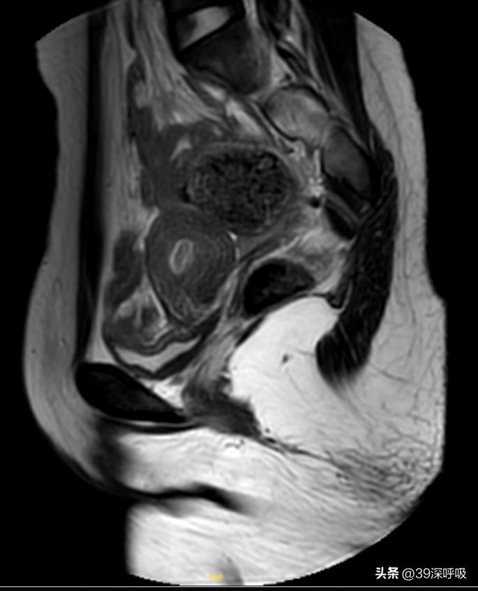 17岁女生从没来过月经，医生妙手为她重塑“女儿身”
