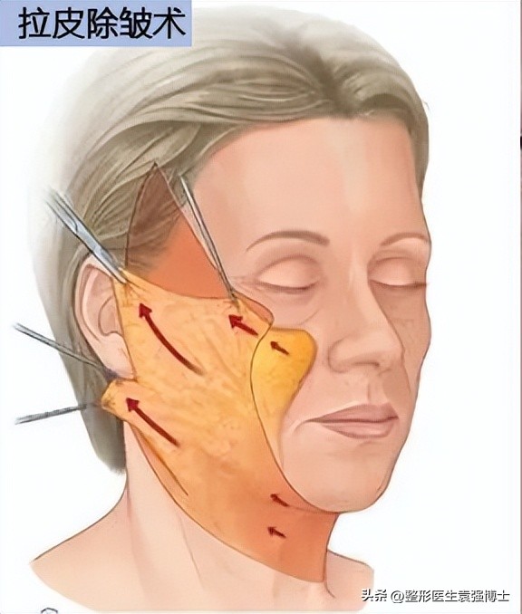 拉皮手术疤痕夸张,耳后切口拉皮疤痕图片