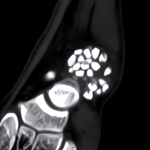 脚踝扭伤的处理方法和康复,脚踝扭伤立即进行的正确处理方法