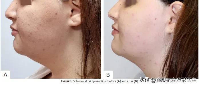 抽脂针瘦脸,抽脂溶脂针