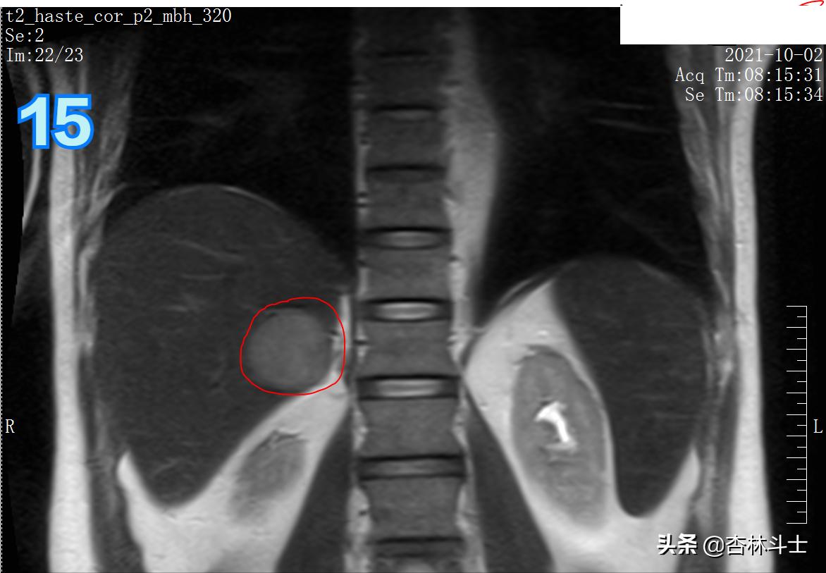 肝癌8公分肿瘤能活多久,肝癌细胞最大长多大