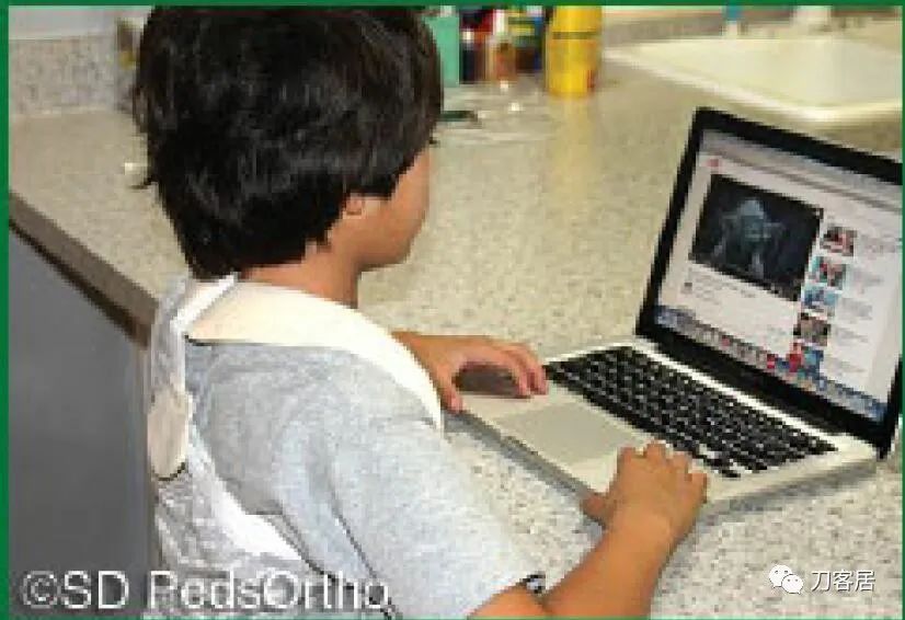 儿童锁骨骨折保守治疗的弊端,锁骨粉碎骨折错位不处理会愈合吗